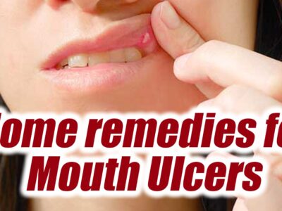 Home remedies for Mouth ulcers