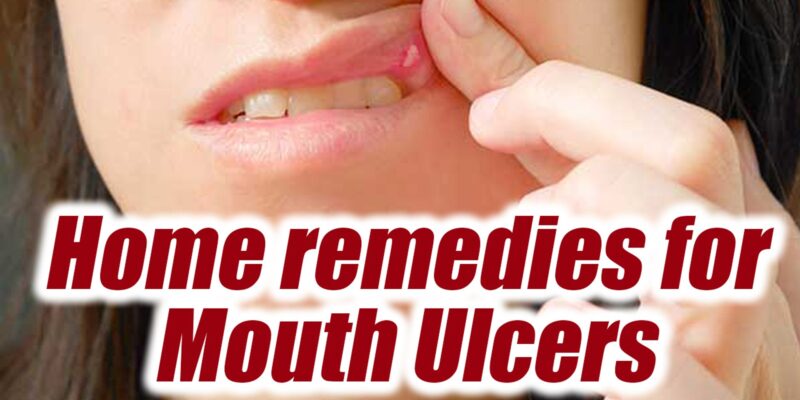 Home remedies for Mouth ulcers