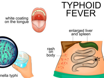 Typhoid Prevention